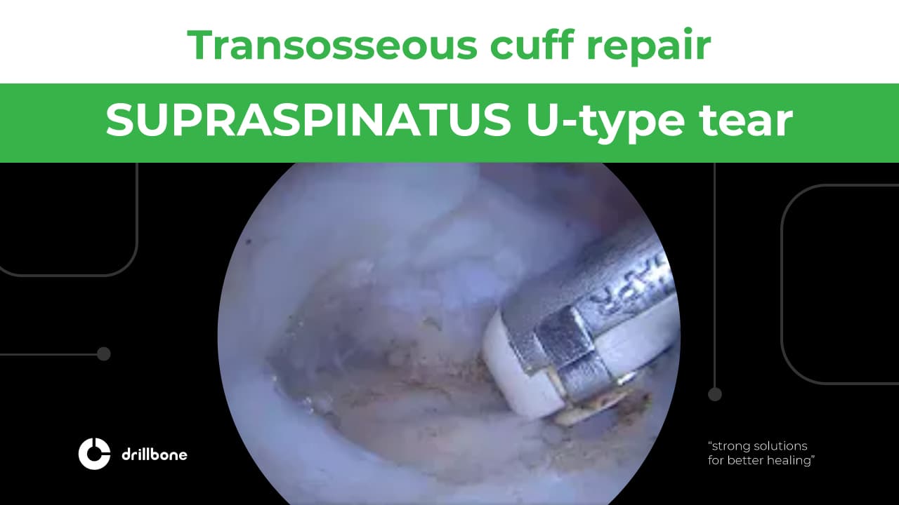 SUPRASPINATUS U TYPE TEAR