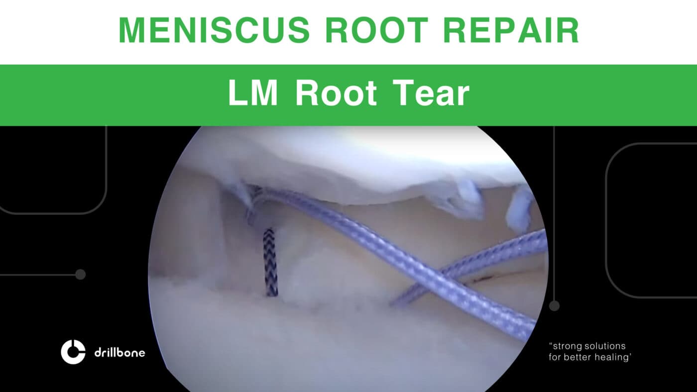 lm root tear NEW kopie